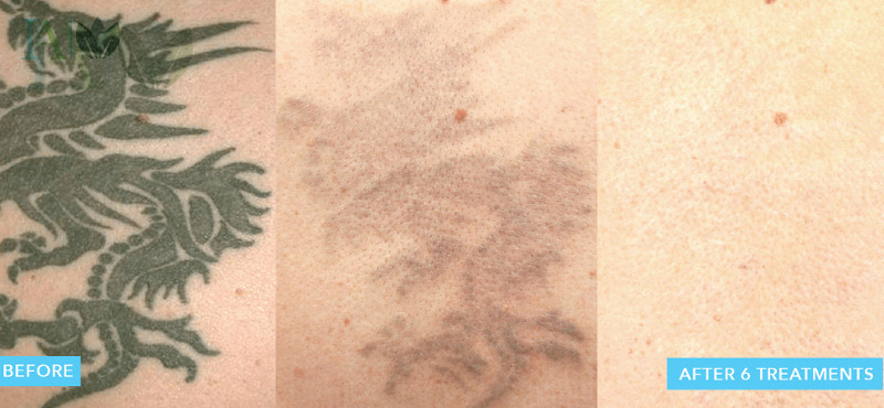 Top 10 Best Tattoo Removal in Cary NC  June 2023  Yelp